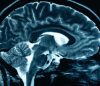 Alzheimer puede detectarse hasta diez años antes de aparecer